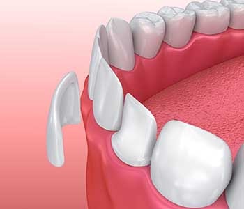 Veneers illustration