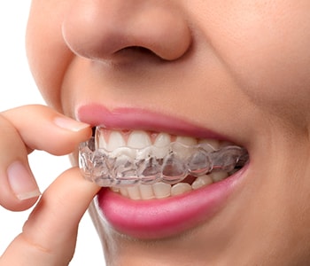 Woman putting in clear aligners