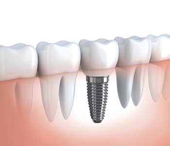 Dental implant illustration