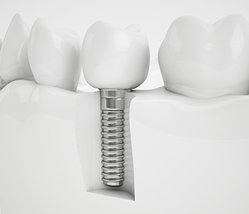 Dental implant illustration