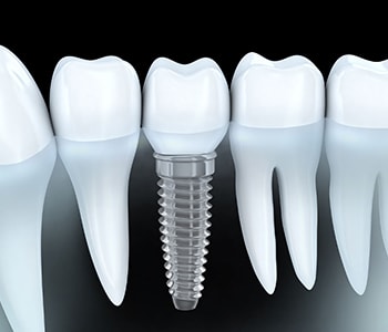 Dental implant illustration