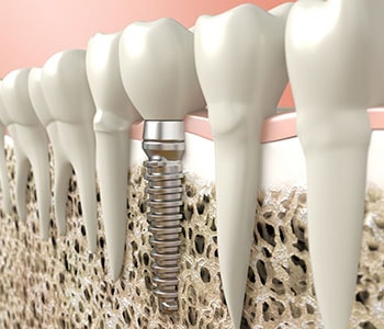 Dental implant illustration