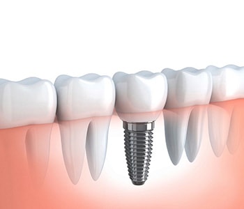 Dental implant illustration