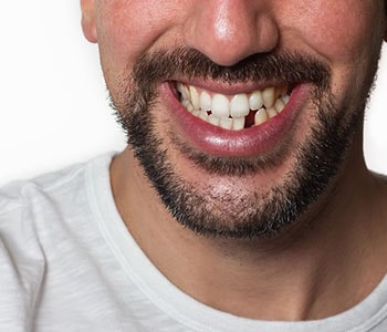 Man with missing tooth