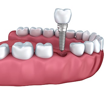 Dental implant illustration