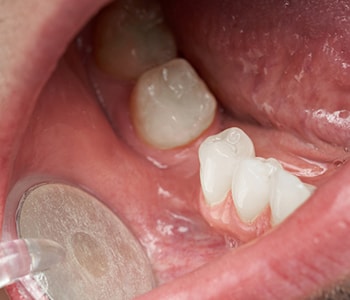 Patient with gum disease