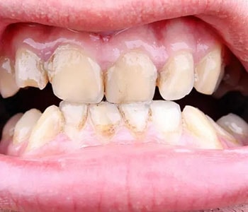 Patient with gum disease