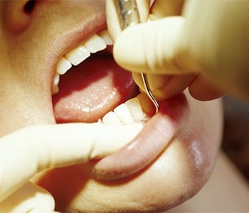 Close-up of patient getting their gums treated