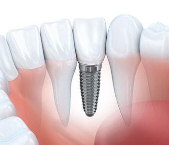 Dental implant illustration