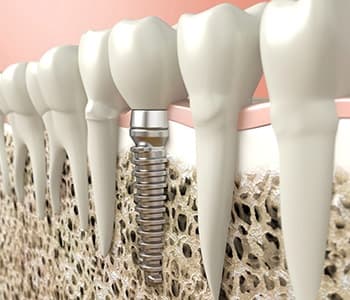 Dental implant illustration