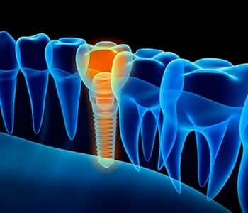 Dental implant illustration