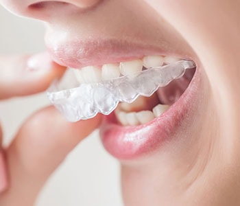 Woman putting in clear aligners