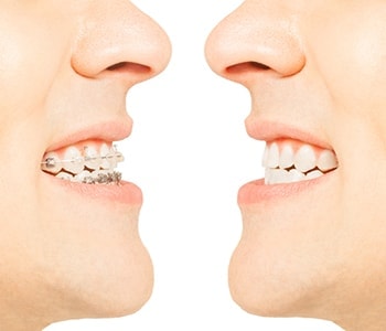 Braces vs. clear aligners