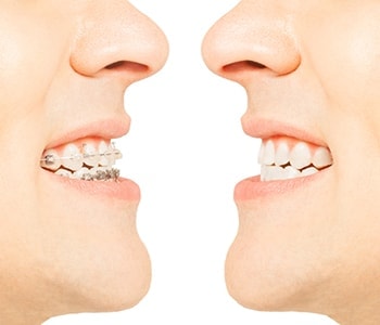 Braces vs. clear aligners