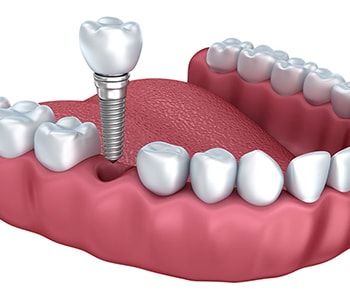 Dental implant illustration