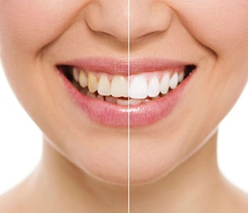 Before and after teeth whitening