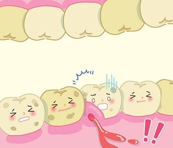 Gum disease illustration