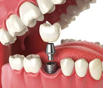 Dental implant illustration