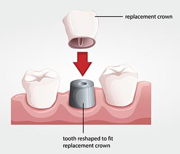 Crowns illustration