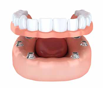 Implant-supported dentures illustration