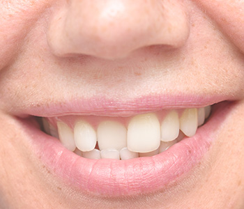 Close-up of patient's smile with crooked teeth