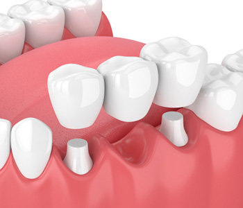 Dental bridge illustration