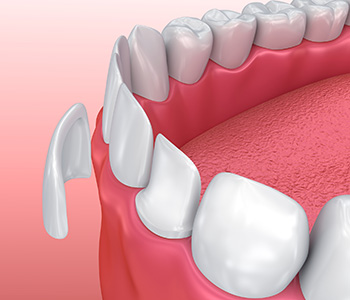 Veneers illustration