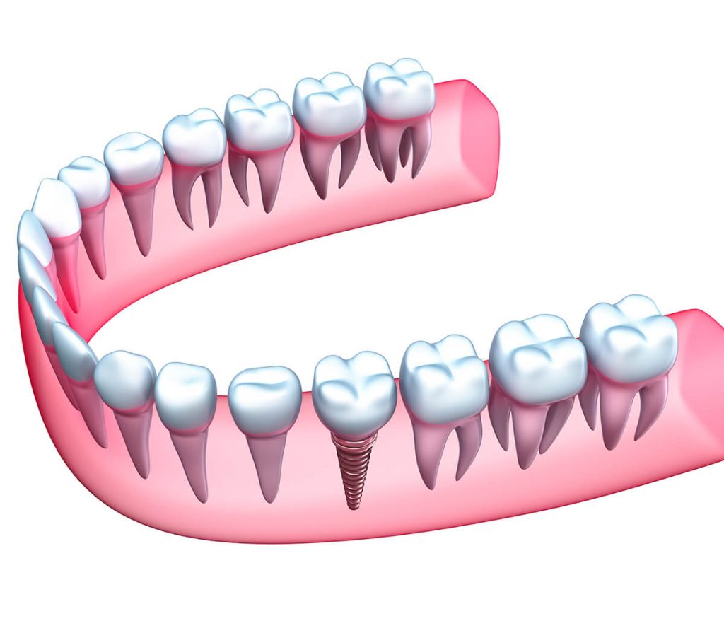 Dental implant illustration