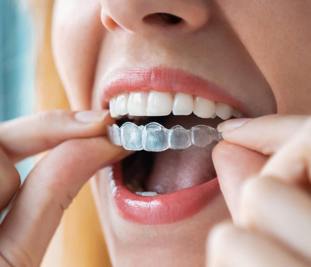 Woman putting in clear aligners