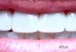 patient's teeth after treatment