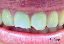Patient's teeth before treatment