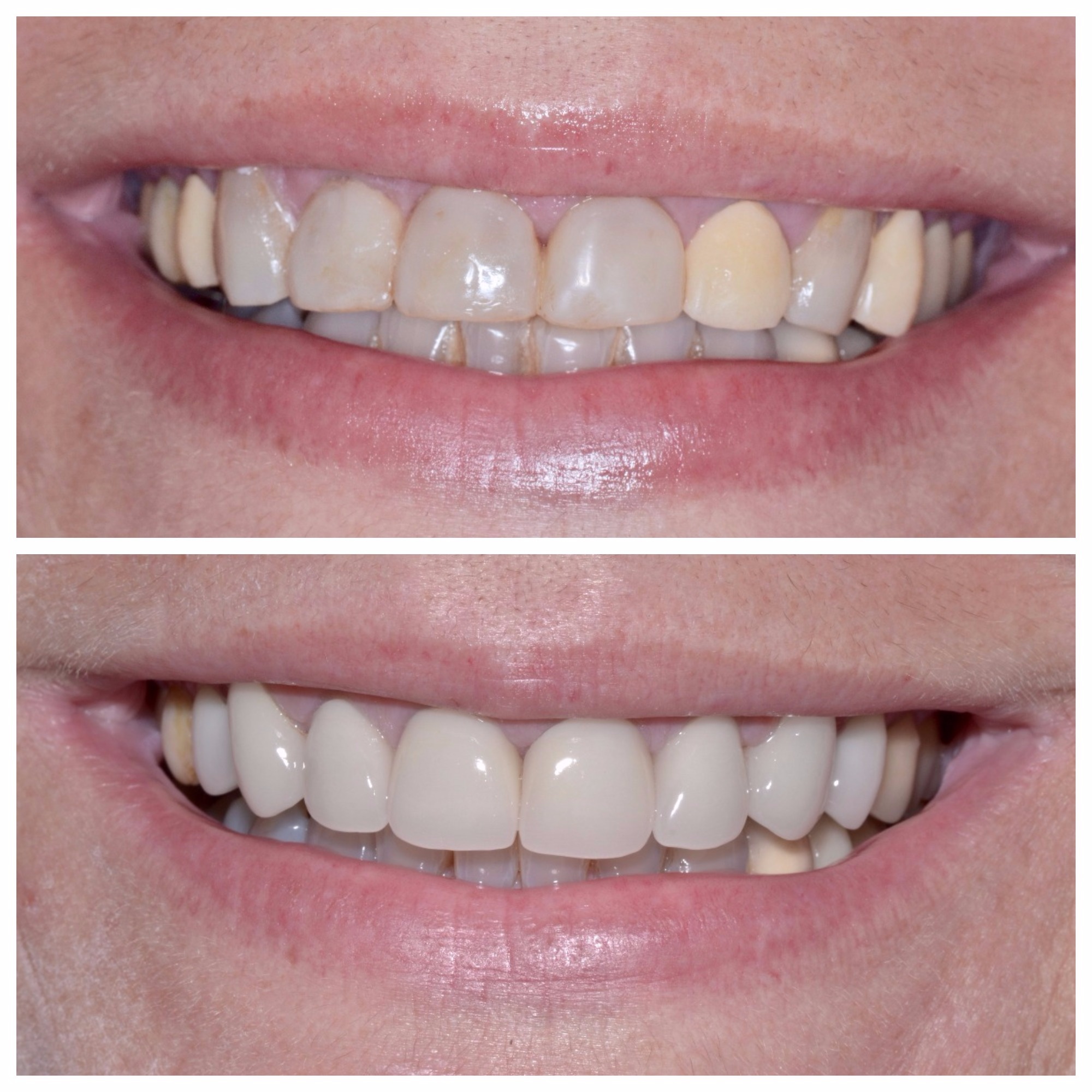 before and after teeth whitening