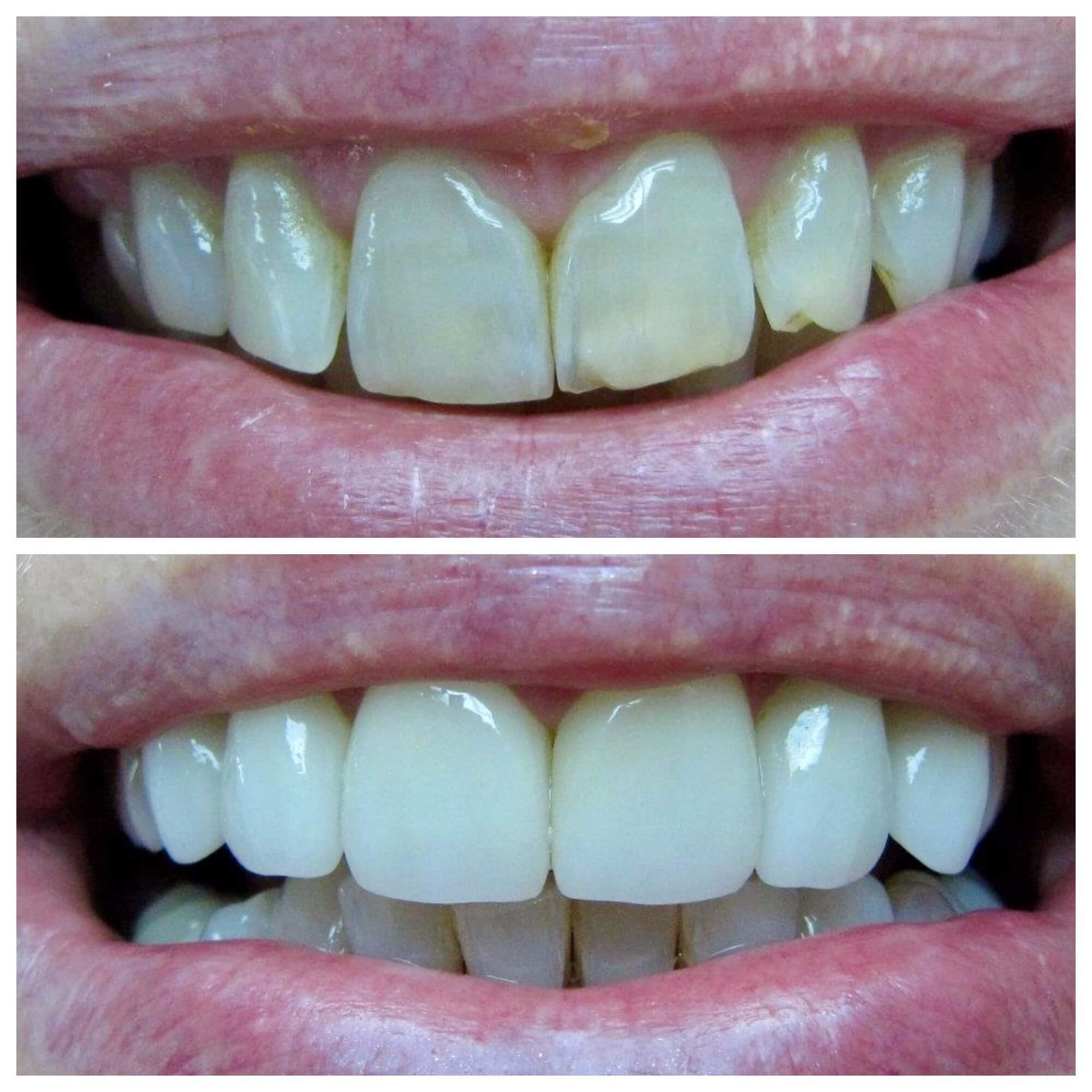 before and after plaque and tartar removal