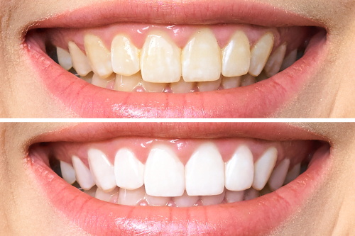 before and after teeth cleaning