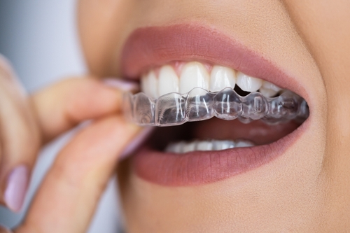 Clear,Aligner,Dental,Night,Guard,For,Teeth