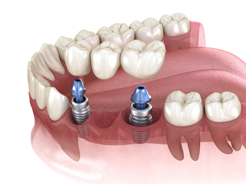 Dental,Bridge,Supported,By,Implants.